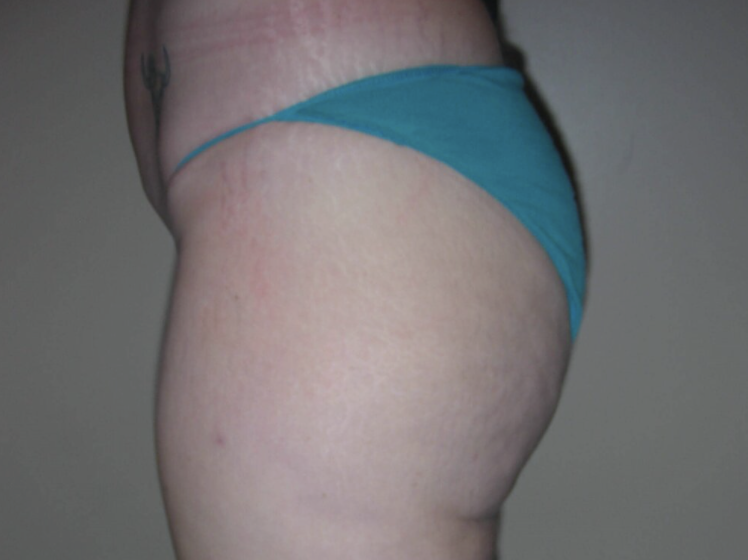 Liposuction before and after - after