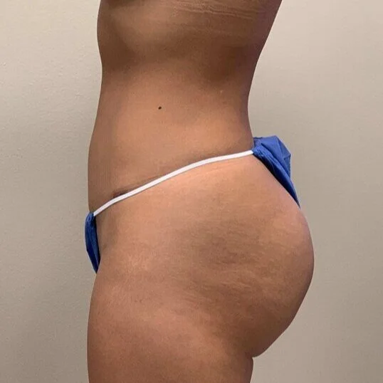 Liposuction before and after - after
