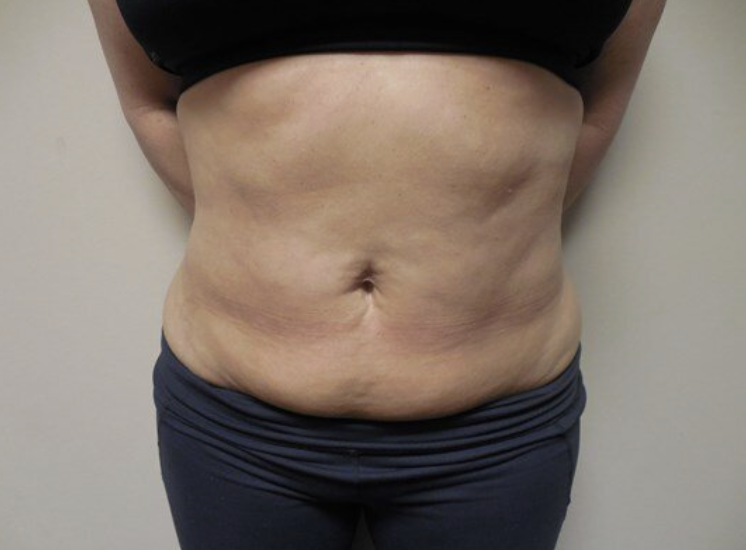 Liposuction before and after - after