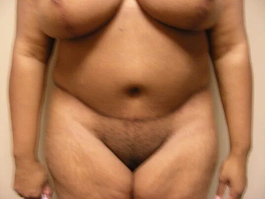 Tummy Tuck before and after - after