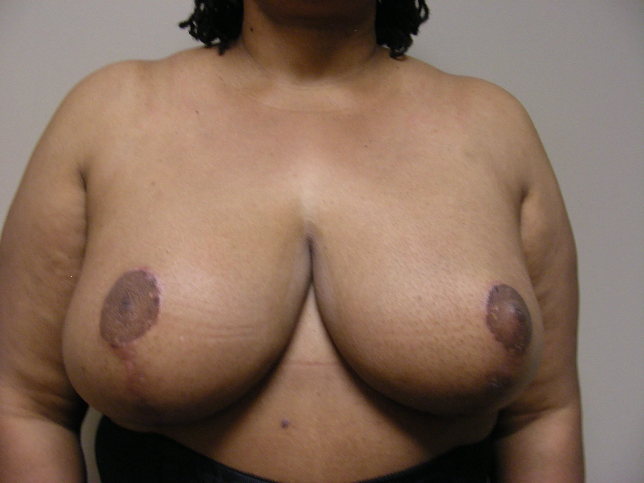 Breast Reduction before and after - after