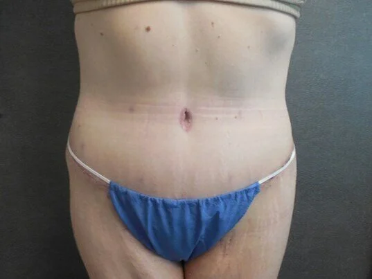 Tummy Tuck before and after - after