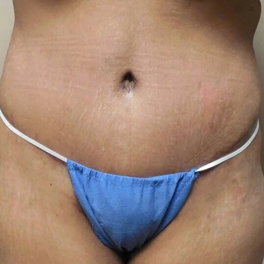 Tummy Tuck before and after - after