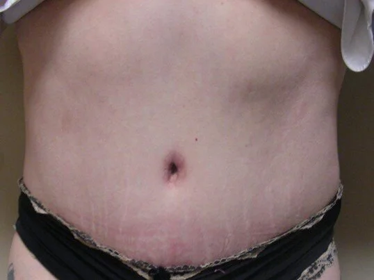 Tummy Tuck before and after - after