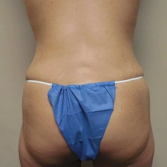 Liposuction before and after - after