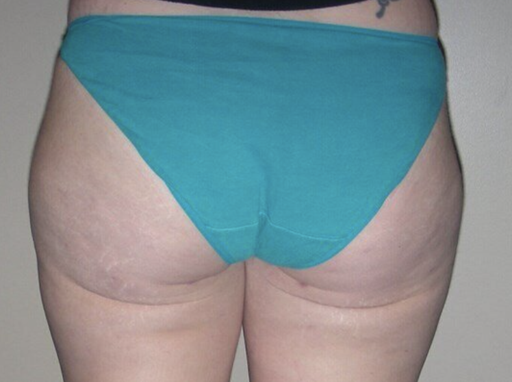 Liposuction before and after - after