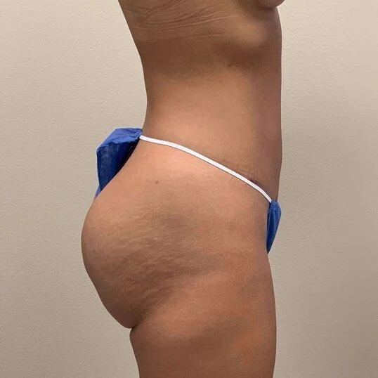 Liposuction before and after - after