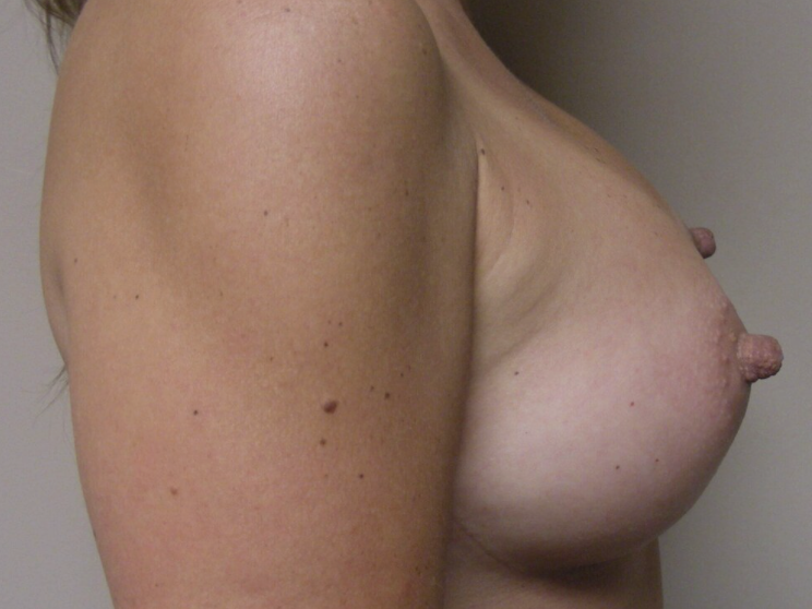Breast Augmentation before and after - after