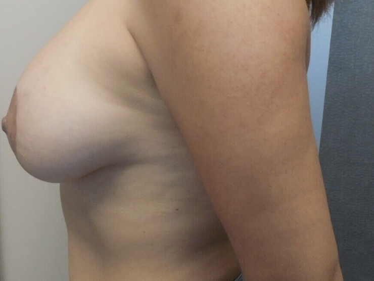 Breast Augmentation before and after - after