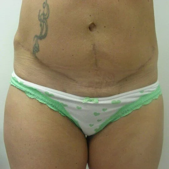 Tummy Tuck before and after - after