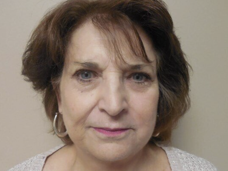 Facelift before and after - after