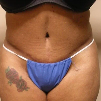 Tummy Tuck before and after - after