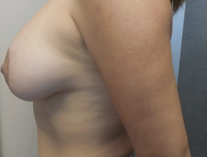 Breast Lift before and after - after