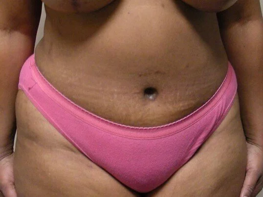 Tummy Tuck before and after - after