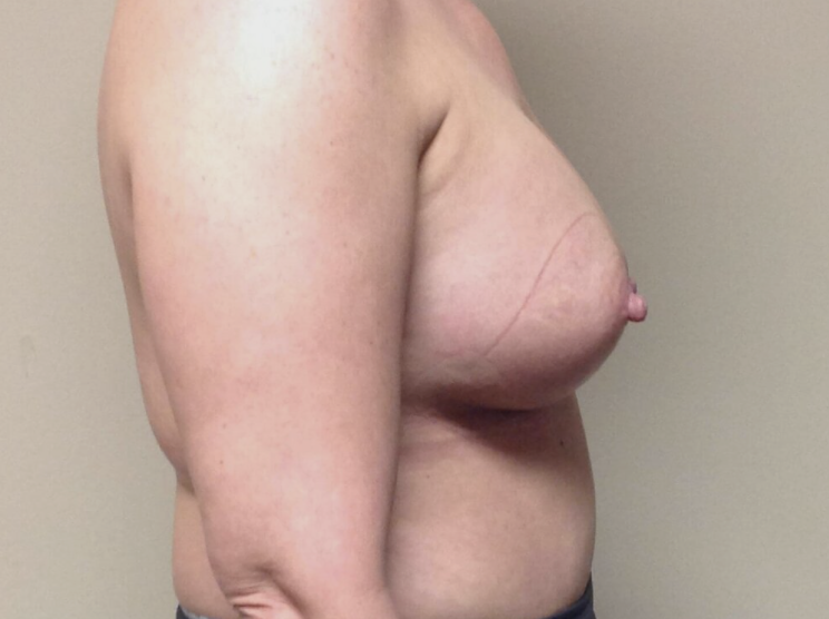 Breast Augmentation before and after - after