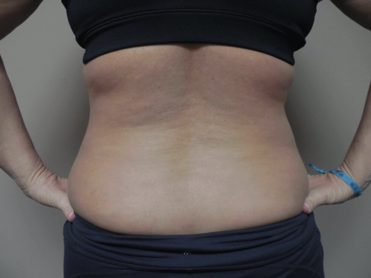 Liposuction before and after - after