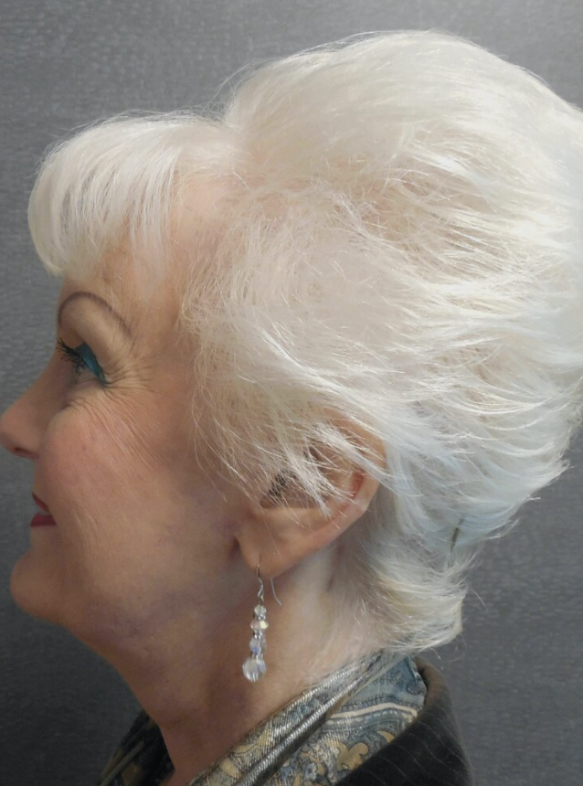 Facelift before and after - after