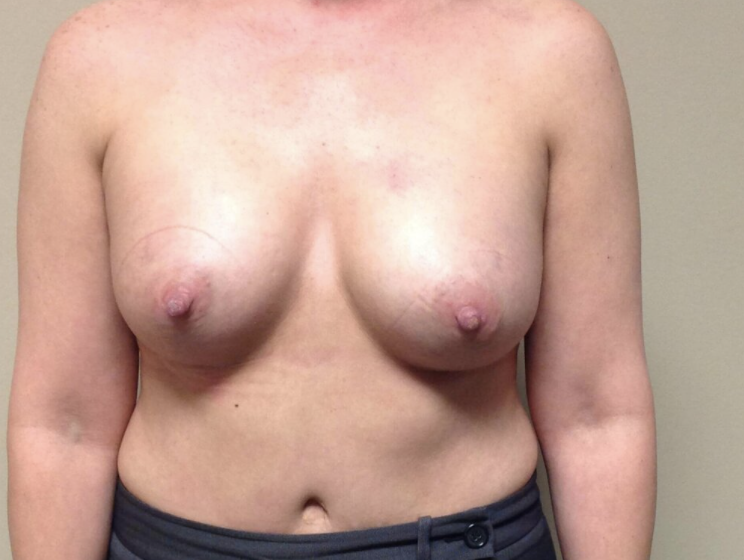 Breast Augmentation before and after - after