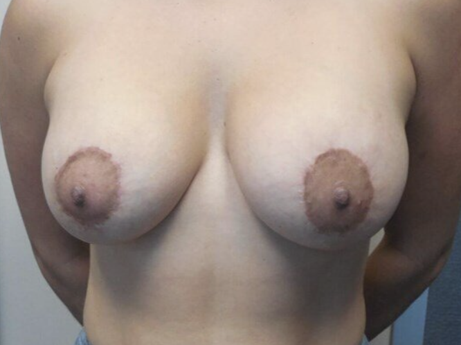 Breast Lift before and after - after