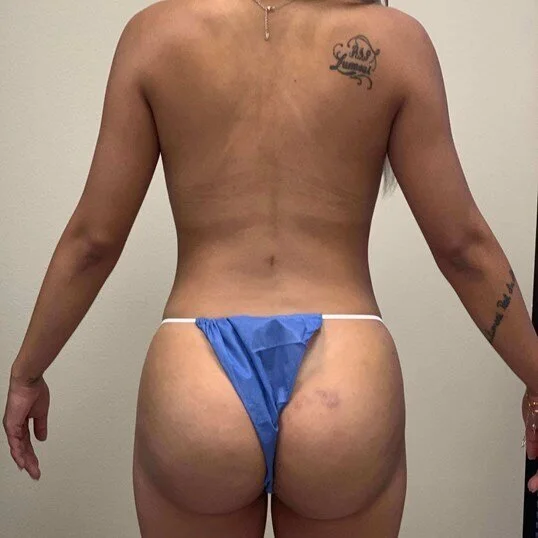 Liposuction before and after - after