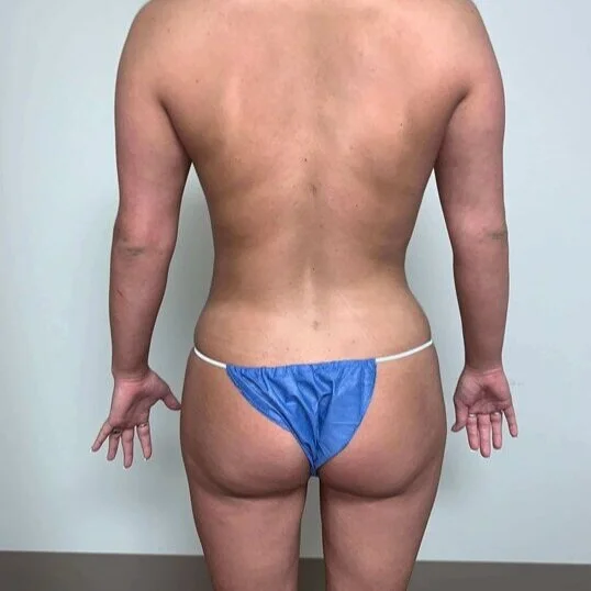 Liposuction before and after - after
