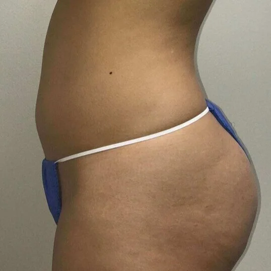 Liposuction before and after - before