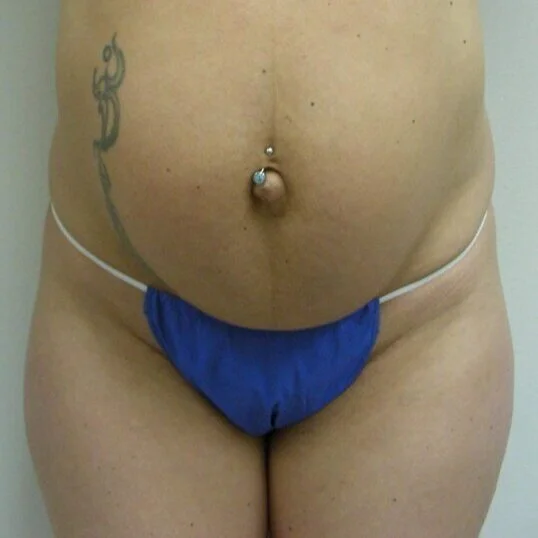 Tummy Tuck before and after - before