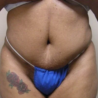 Tummy Tuck before and after - before