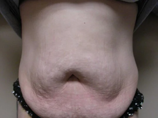 Tummy Tuck before and after - before