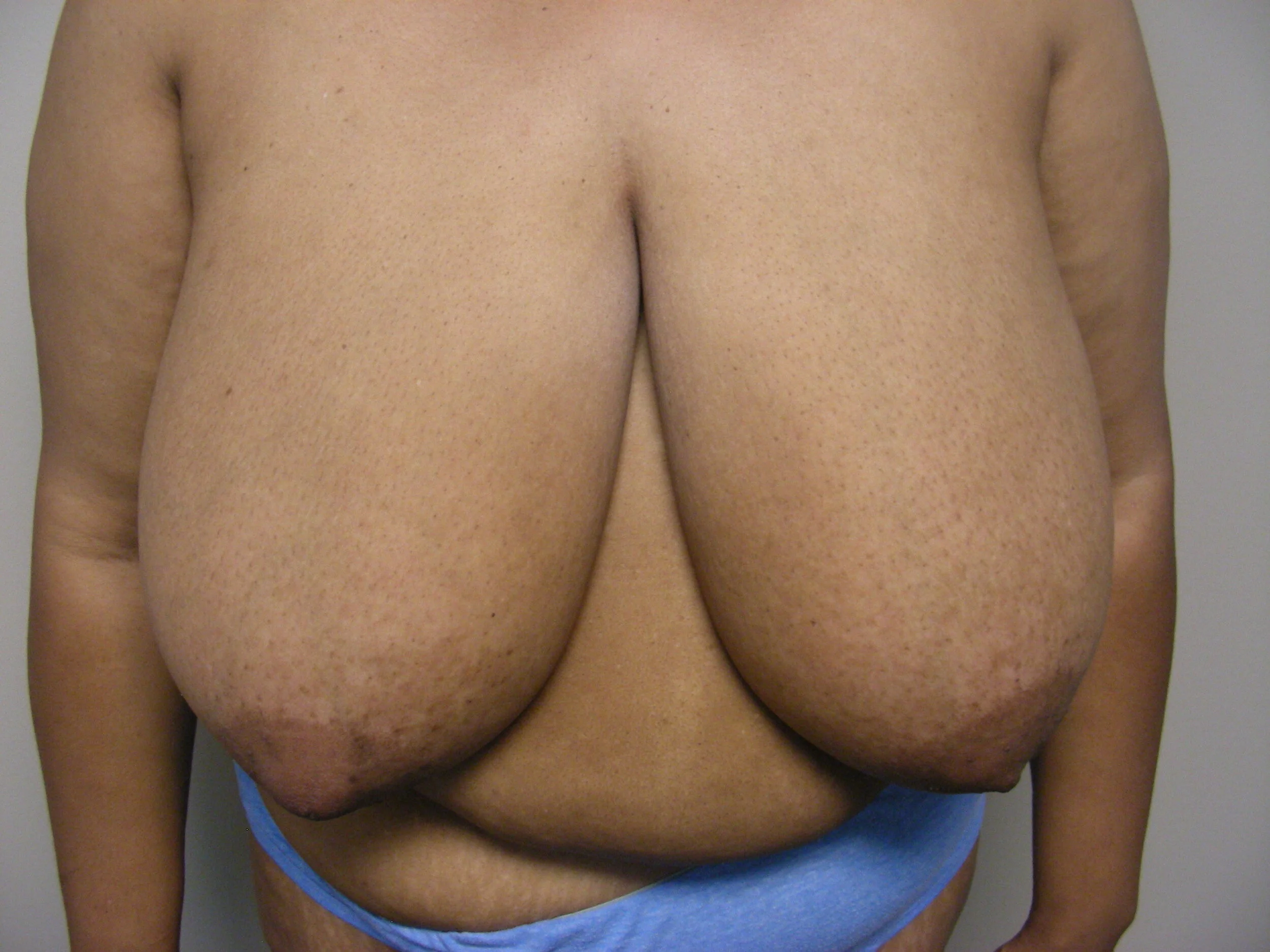 Breast Reduction before and after - before
