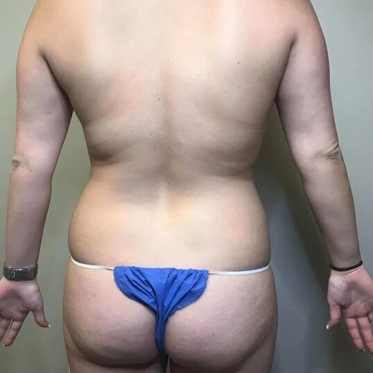 Liposuction before and after - before