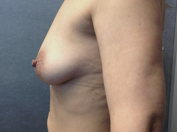 Breast Augmentation before and after - before