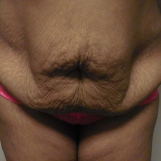 Tummy Tuck before and after - before