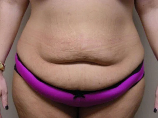 Tummy Tuck before and after - before