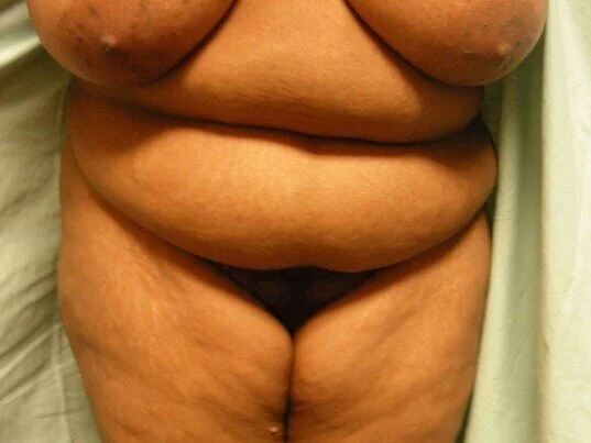 Tummy Tuck before and after - before