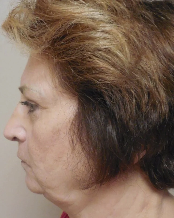 Facelift before and after - before
