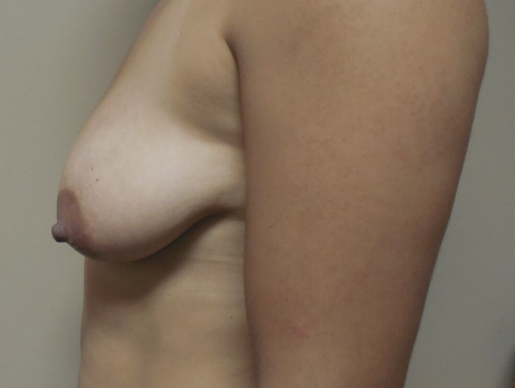 Breast Augmentation before and after - before