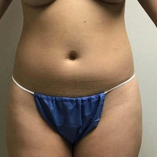 Liposuction before and after - before