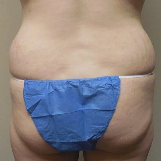 Liposuction before and after - before