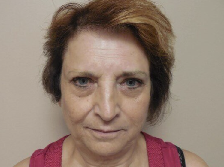 Facelift before and after - before