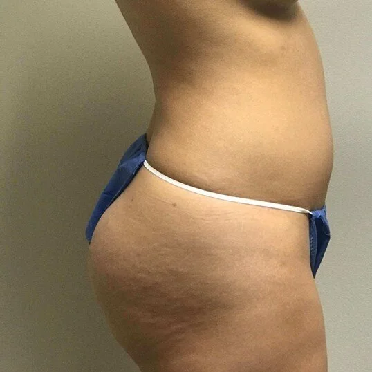 Liposuction before and after - before