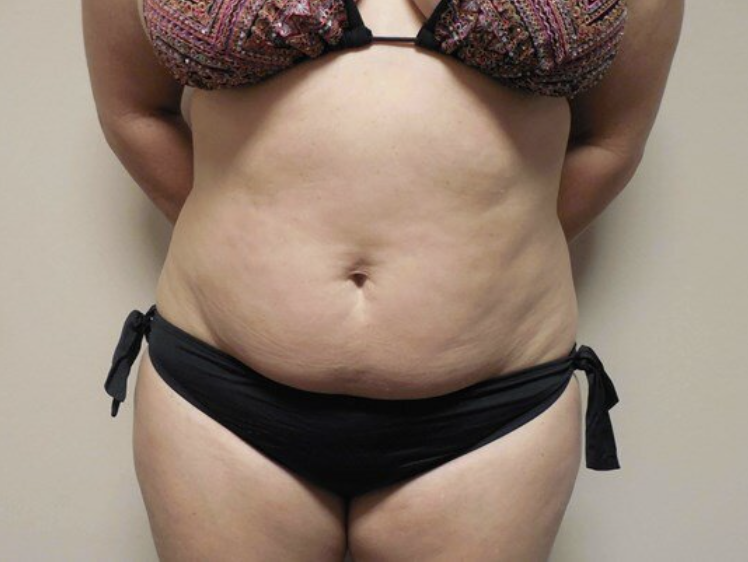Liposuction before and after - before
