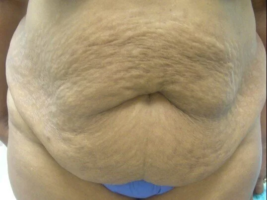 Tummy Tuck before and after - before