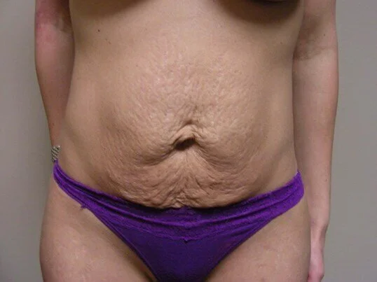 Tummy Tuck before and after - before