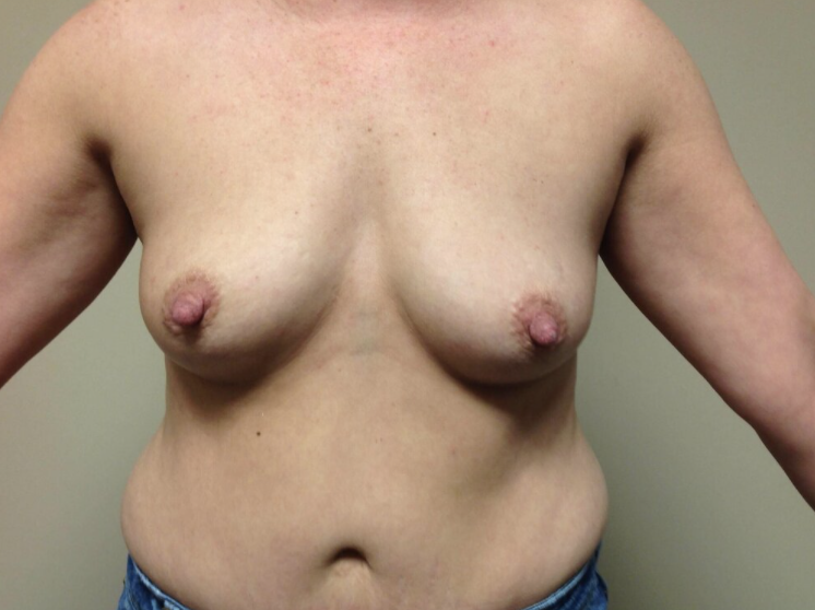 Breast Augmentation before and after - before