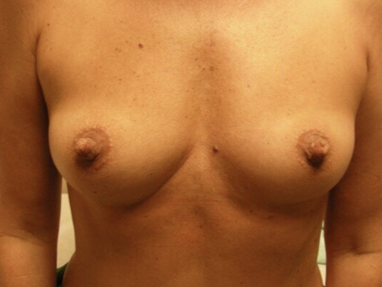 Breast Augmentation before and after - before