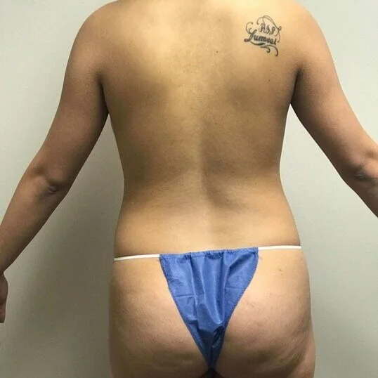 Liposuction before and after - before