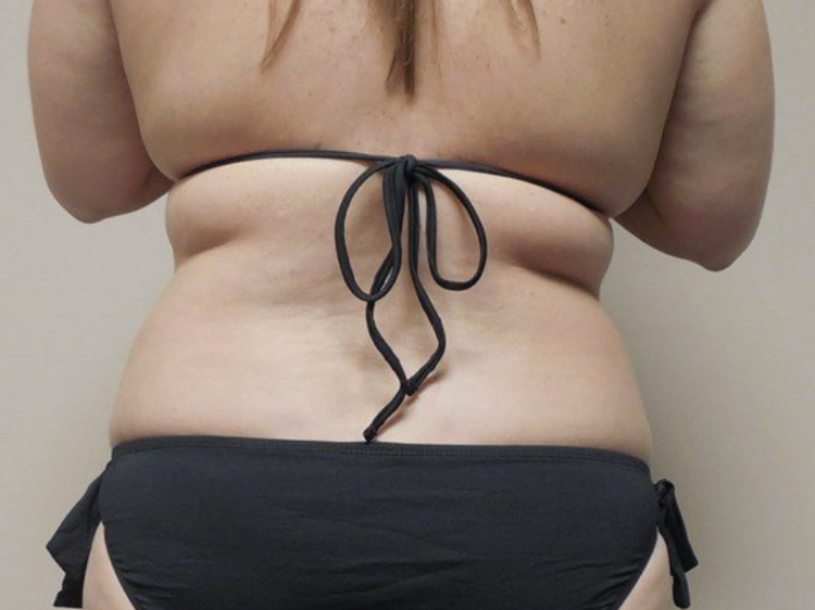 Liposuction before and after - before