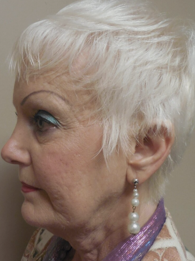 Facelift before and after - before