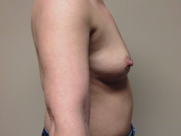 Breast Augmentation before and after - before